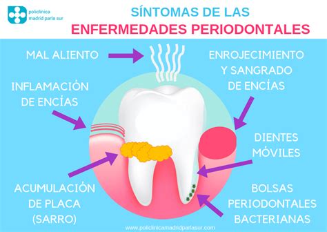 síntomas de periodontitis